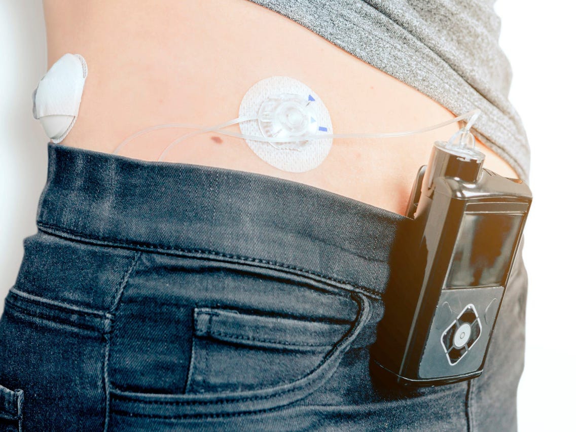 Insulin Pumps Vs Injections: A Case for Convenience